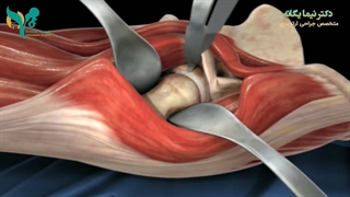 فیلم تعویض مفصل ران