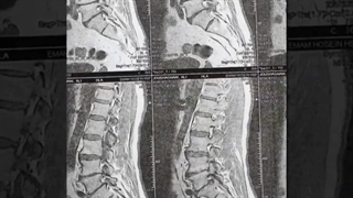 آقای ۶۰ ساله با درد شدید کمری ؛ ناتوانی در راه رفتن