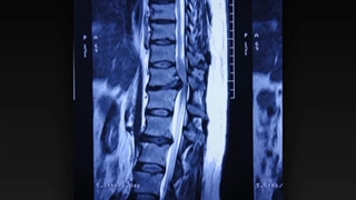 Thoracic disc