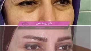 بلفاروپلاستی پلک بالا و پایین