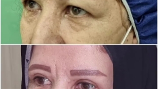 بلفاروپلاستی پلک بالا