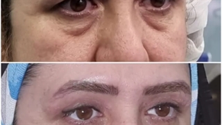بلفاروپلاستی و جراحی پلک فوقانی