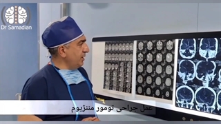 عمل جراحی تومور مننژیوم