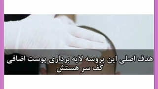 زمان رنگ کردن موها بعد از کاشت مو
